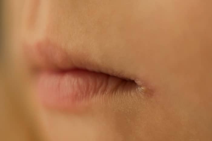 โรคปากนกกระจอก (Angular cheilitis)