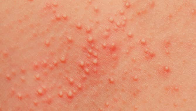 โรคขนคุด (Keratosis Pilaris)