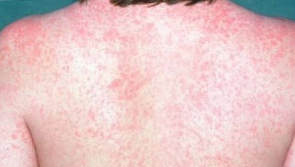 โรคหัด (Measles) : อาการ สาเหตุ การรักษ