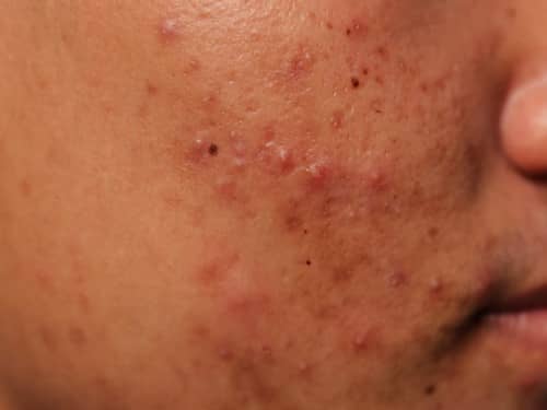 Inflamed acne