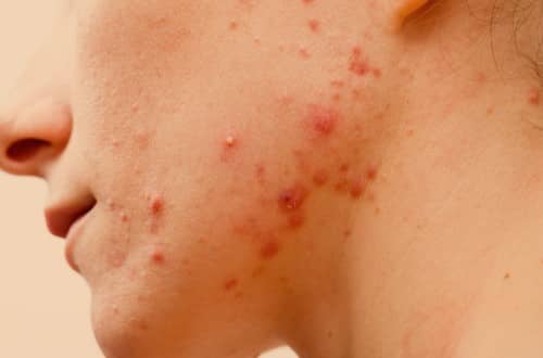 สิวอักเสบ (Inflamed acne) : อาการ สาเหตุ วิธีการรักษา