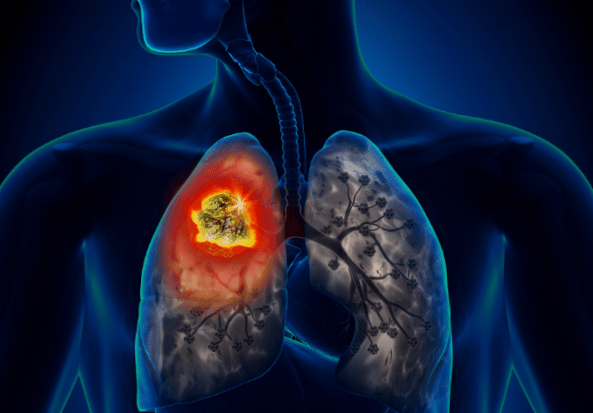 โรคมะเร็งปอด (Lung Cancer)