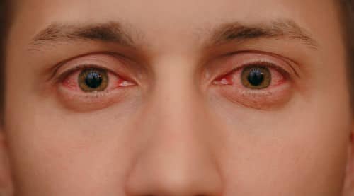 ตาเเดง (Conjunctivitis) : อาการ สาเหตุ การรักษา