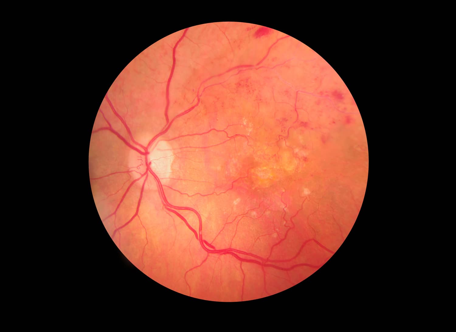 โรคเบาหวานขึ้นจอประสาทตา (Diabetic retinopathy) : อาการ สาเหตุ การรักษา