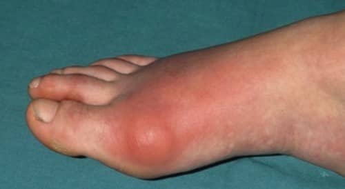 โรคเก๊าต์ (Gout) : อาการ สาเหตุ การรักษา