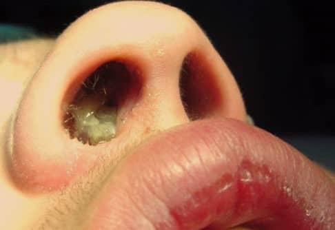 โรคริดสีดวงจมูก (Nasal Polyps) : อาการ สาเหตุ การรักษา
