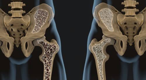 โรคกระดูกพรุน (Osteoporosis) : อาการ สาเหตุ การรักษา