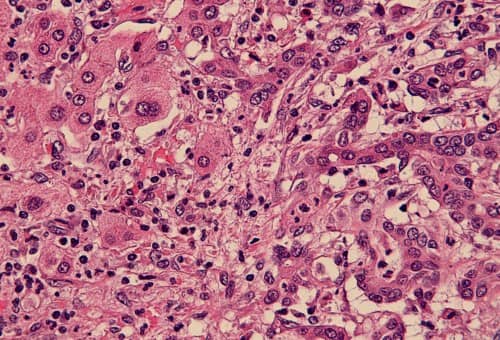 มะเร็งท่อน้ำดี (Cholangiocarcinoma) : อาการ สาเหตุ การรักษา
