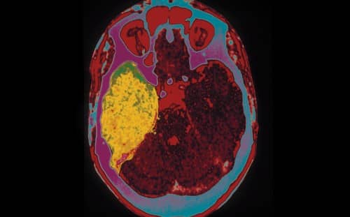 Encephalitis