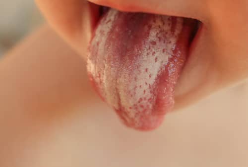 ลิ้นเป็นฝ้า (White Tongue) : อาการ สาเหตุ การรักษา