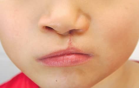 ปากแหว่งเพดานโหว่ (Cleft Lip and Cleft Palate) : อาการ สาเหตุ การรักษา