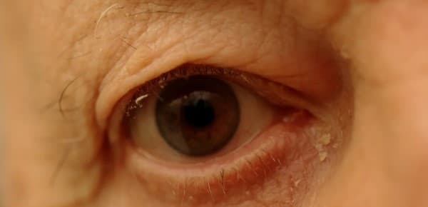 ขี้ตาเยอะ (A lot of Eye Crust) : อาการ สาเหตุ การรักษา
