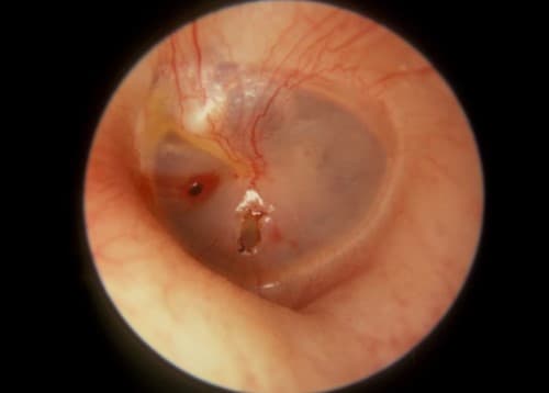 แก้วหูทะลุ (Ruptured Eardrum) : อาการ สาเหตุ การรักษา