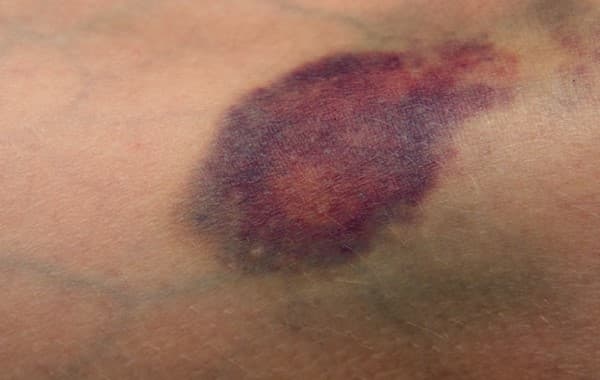 รอยฟกช้ำ (Bruise) : อาการ สาเหตุ การรักษา