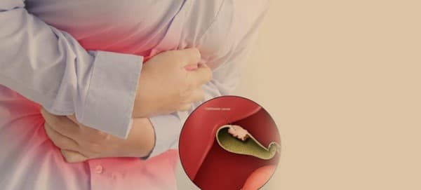 มะเร็งถุงน้ำดี (Gallbladder Cancer) : อาการ สาเหตุ การรักษา