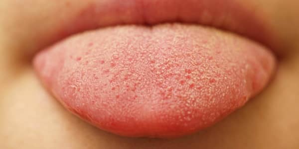เชื้อราในปาก (Oral Thrush) : อาการ สาเหตุ การรักษา