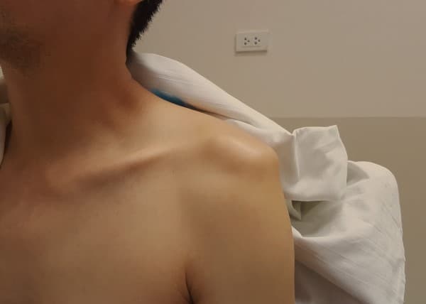 ไหล่หลุด (Dislocated Shoulder) : อาการ สาเหตุ การรักษา
