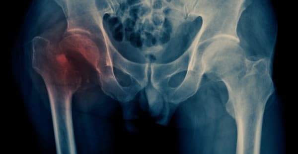 Hip fracture