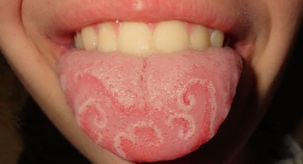 ลิ้นอักเสบ (Glossitis) : อาการ สาเหตุ การรักษา