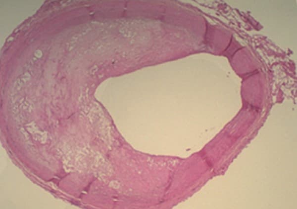 ภาวะหลอดเลือดแข็ง (Atherosclerosis) : อาการ สาเหตุ การรักษา 