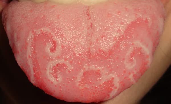 Geographic Tongue