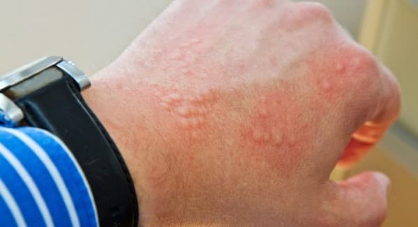 แพ้ยาง (Latex allergy) : อาการ สาเหตุ การรักษา