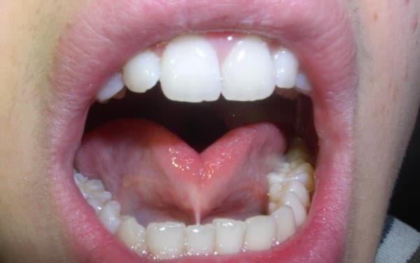 ภาวะลิ้นติด (Tongue-tie) : อาการ สาเหตุ การรักษา