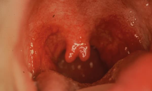 ลิ้นไก่อักเสบ (Swollen Uvula) : อาการ สาเหตุ การรักษา