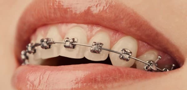 การจัดฟัน (Braces) : สิ่งควรรู้ และข้อควรระวัง