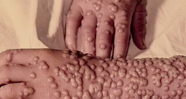 Smallpox Vaccine Scars