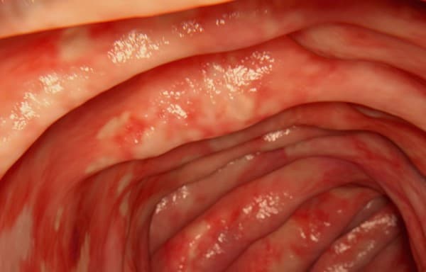 โรคลำไส้อักเสบ (Ulcerative Colitis) : อาการ สาเหตุ การรักษา