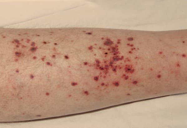 โรคหลอดเลือดอักเสบ (Vasculitis) : อาการ สาเหตุ การรักษา