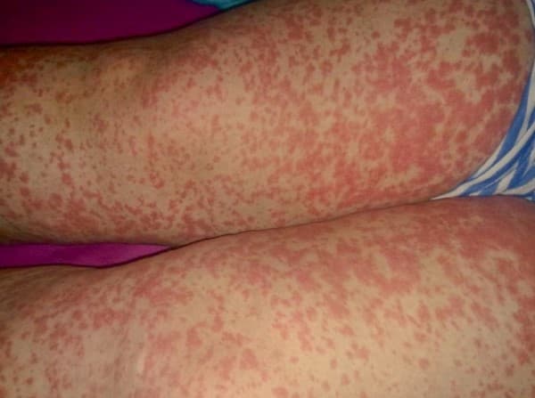 Vasculitis