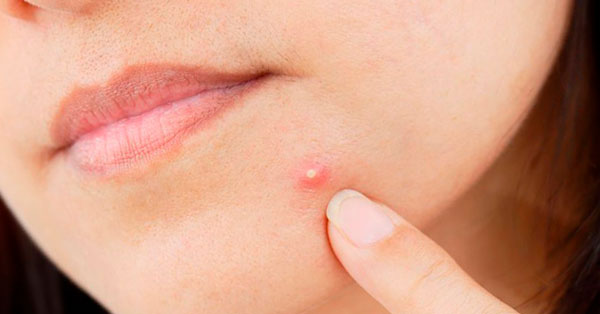Inflamed Acne