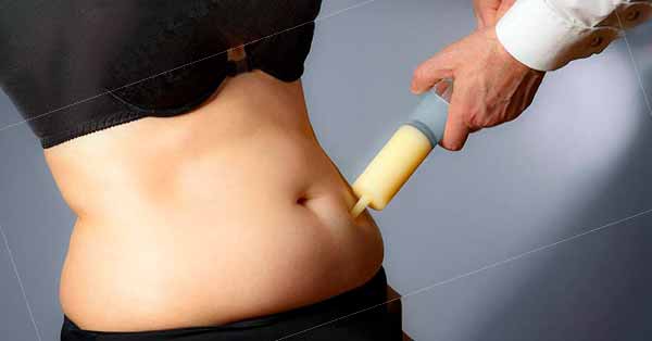 สิ่งที่ควรรู้เกี่ยวกับการดูดไขมัน (What We Need to Know About Liposuction)