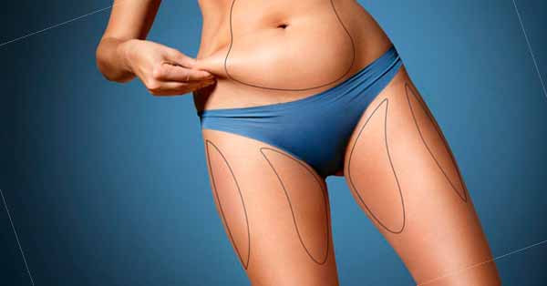 What We Need to Know About Liposuction