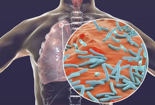 วัณโรค Tuberculosis (TB) : อาการ สาเหตุ การรักษา