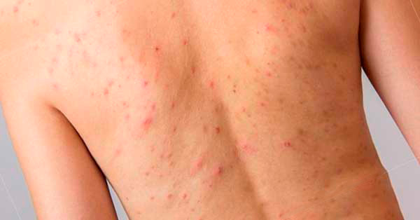 Type of Back Acne and Prevention