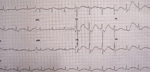 ภาวะโพแทสเซียมในเลือดต่ำ (Hypokalemia-Low Potassium in Blood)