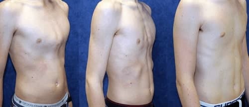 กระดูกกลางอกปูดหรือโรคอกไก่ (Pectus Carinatum) 