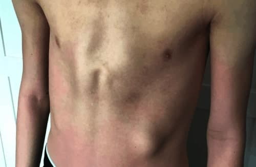 Pectus Carinatum