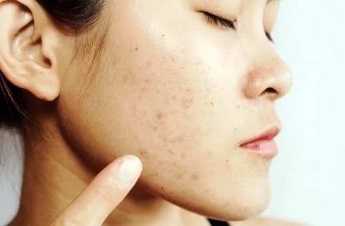 Get Rid of Acne Mark