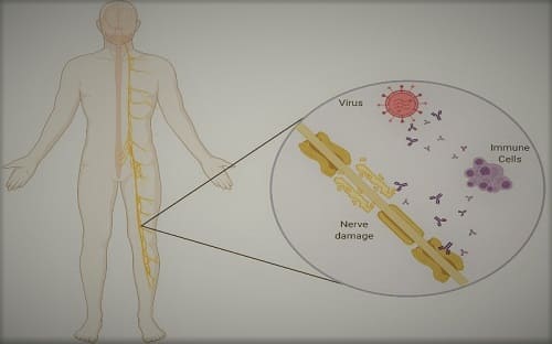 โรคกิลแรงบาเร (Guillain Barre Syndrome)