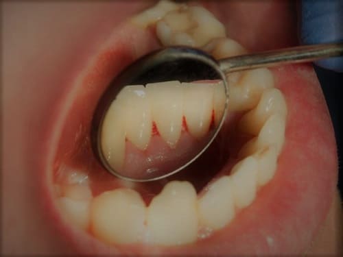 เสียวฟัน (Tooth Sensitivity)
