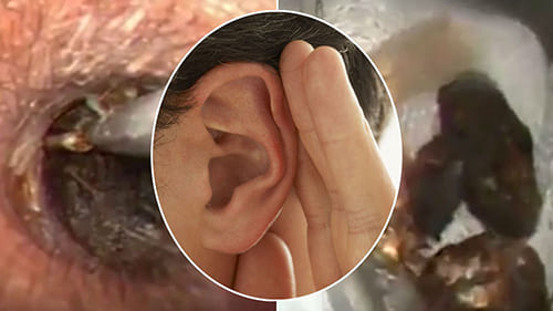 วิธีแก้แมลงเข้าหู (Insects in Ear)