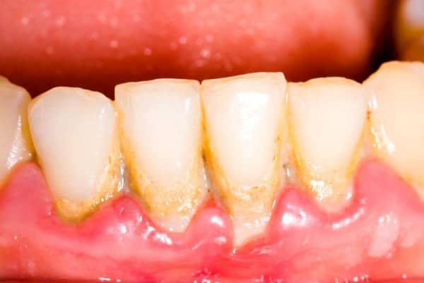 คราบฟัน (Dental Plaque)
