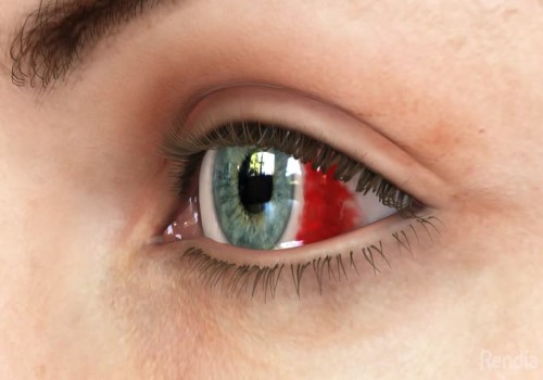 เส้นเลือดฝอยตาแตก (Subconjunctival Hemorrhage)