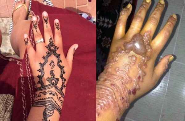 รอยสักเฮนน่าและความปลอดภัยของวัยรุ่น (Henna Tattoo and its Safety)