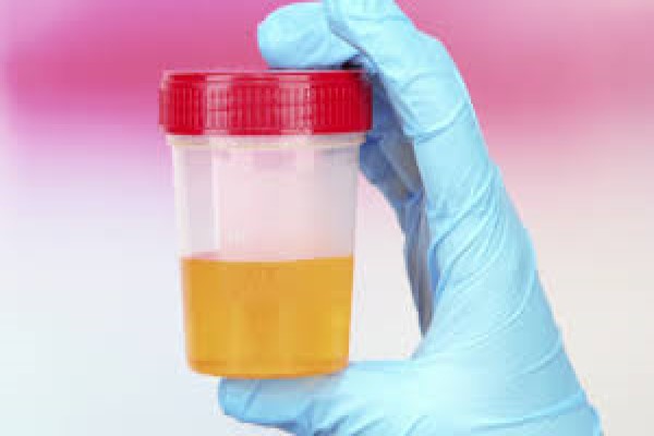 การตรวจปัสสาวะ (Urinalysis)