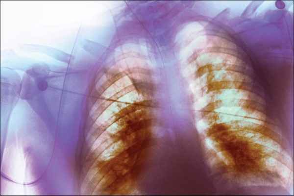 กลุ่มอาการหายใจลำบากเฉียบพลัน (Acute Respiratory Distress Syndrome)